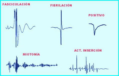 Imagen descriptiva de la actividad EMG en reposo, con las seales de Fasciculacion, Fibrilacion, positivo, miotonia, e Insercion