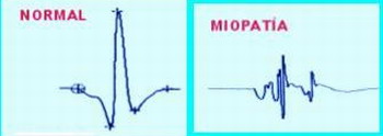 Imagen descriptiva de la actividad EMG de la Unidad Motora Normal, y otra con Miopatia