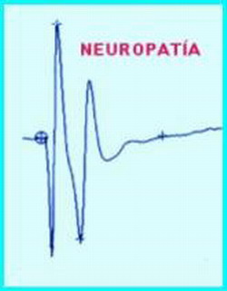 Imagen descriptiva de la actividad EMG de la Unidad Motora con Neuropatia